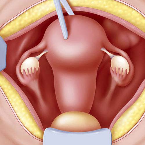 Abdominal Hysterectomy