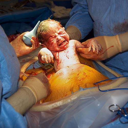 Cesarean section in Guntur