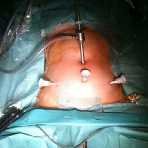 Laparoscopic hysterectomy in Guntur