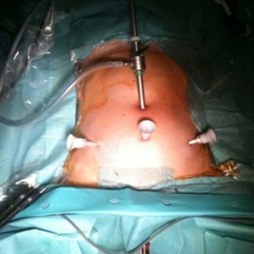 Laparoscopic hysterectomy