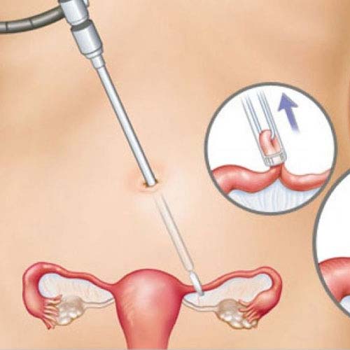 Laparoscopic Tubectomy