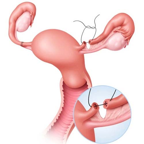 Tube recanalization