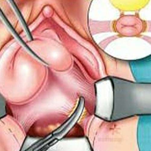 Vaginal hysterectomy